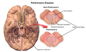 La ricerca e la malattia di Parkinson 2